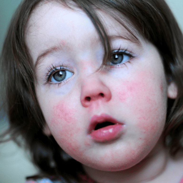 Rashes in children - Child Matters