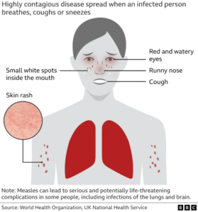 Measles