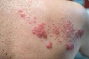Shingles in children