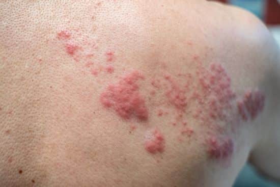 Shingles